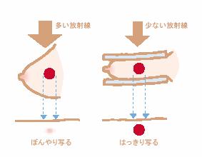 乳房X線装置(マンモグラフィ)画像1
