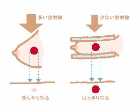 乳房X線装置（マンモグラフィ）画像1