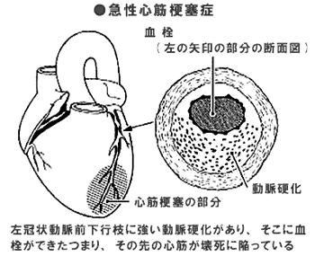 心筋梗塞症