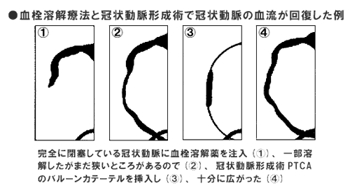 血流回復事例