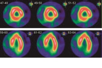 心筋血流シンチ画像