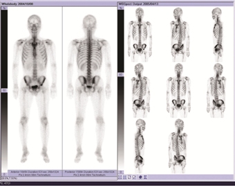骨シンチ画像